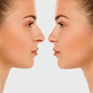 Rhinoplasty